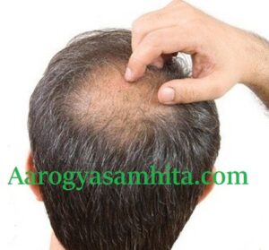 Baldness Home Remedies. How to Regrow Hair on Bald Spot Fast?