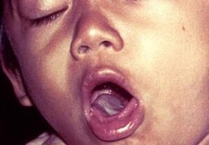 Whooping Cough (Pertussis)